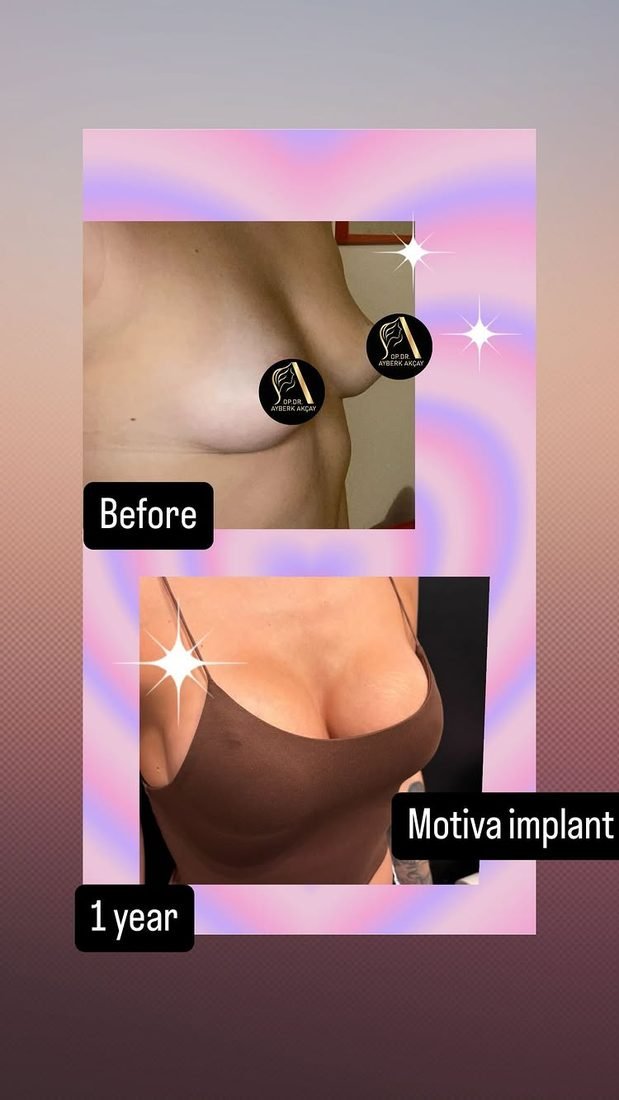 Breast augmentation with a Motiva implant, her own photo one year after