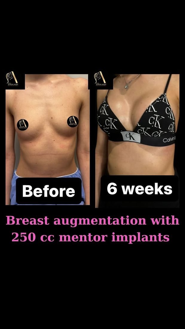 Aumento de mama con implantes Mentor de 250 cc, antes y después a las seis semanas