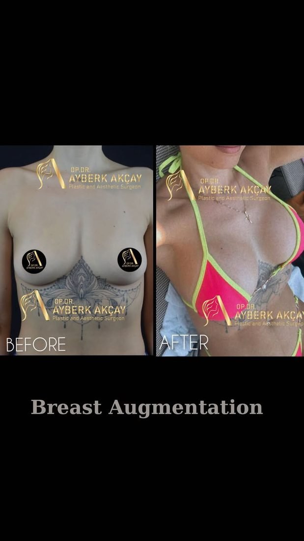 Breast augmentation patient, clinic photo before and her own bikini photo after