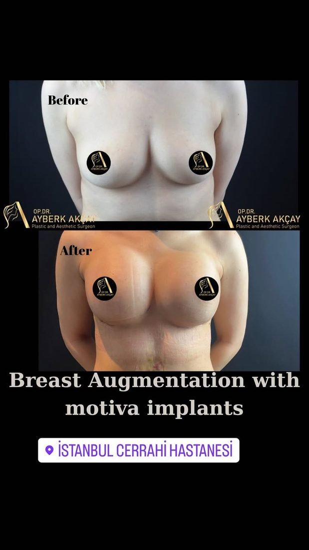 Breast augmentation with Motiva implants, photographed while bruising was still settling