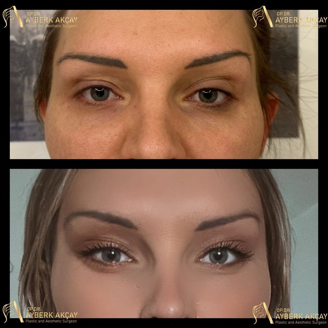 Eye-area rejuvenation before and after, fully healed