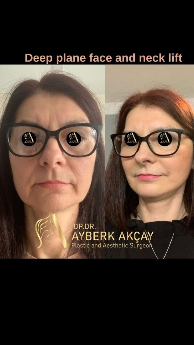 Deep plane face and neck lift before and after — jawline and jowl improvement