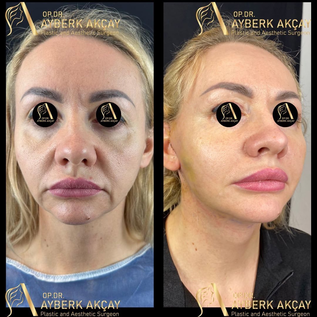 Deep plane face and neck lift before and after — front and three-quarter views