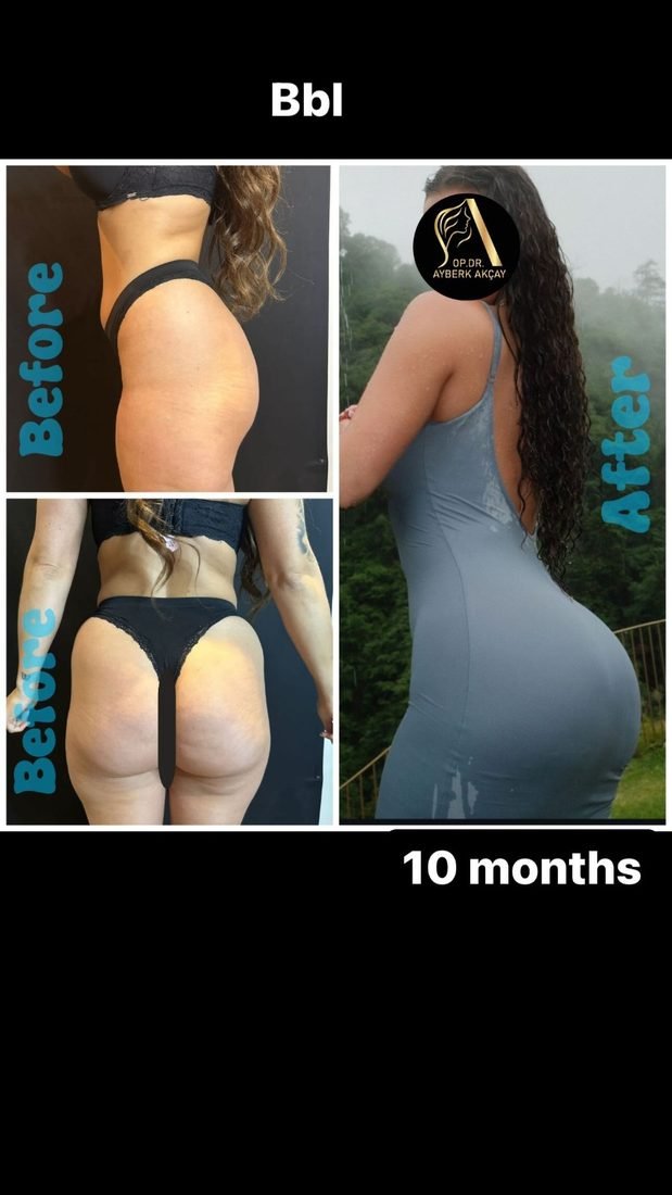 Liposucción con transferencia de grasa a los diez meses, el después fotografiado al aire libre