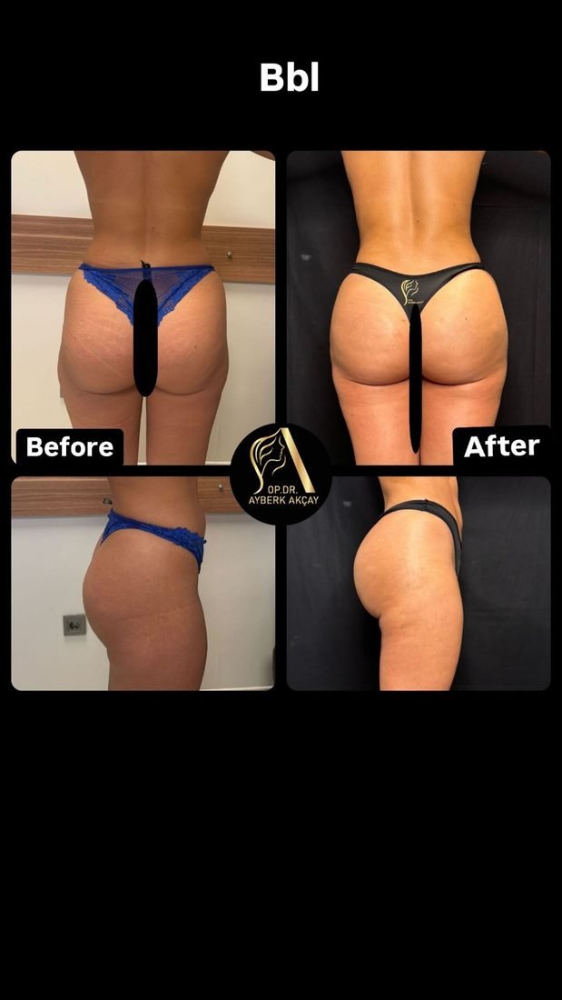 Liposucción con transferencia de grasa, antes y después, resultado curado en dos ángulos