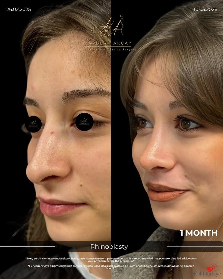 Rhinoplasty before and after, one month, three-quarter view