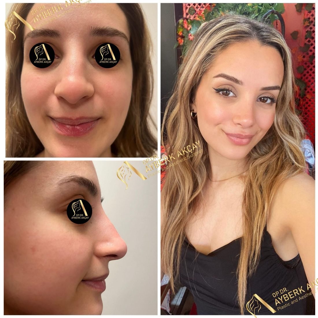 Rhinoplasty patient, clinic photos before and her own photo after