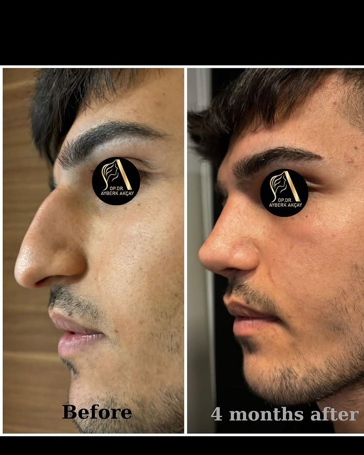 Male rhinoplasty before and after, four months, dorsal hump removed