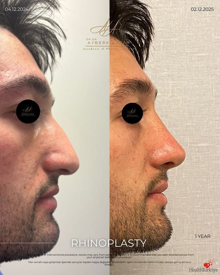 Male rhinoplasty before and after, one year