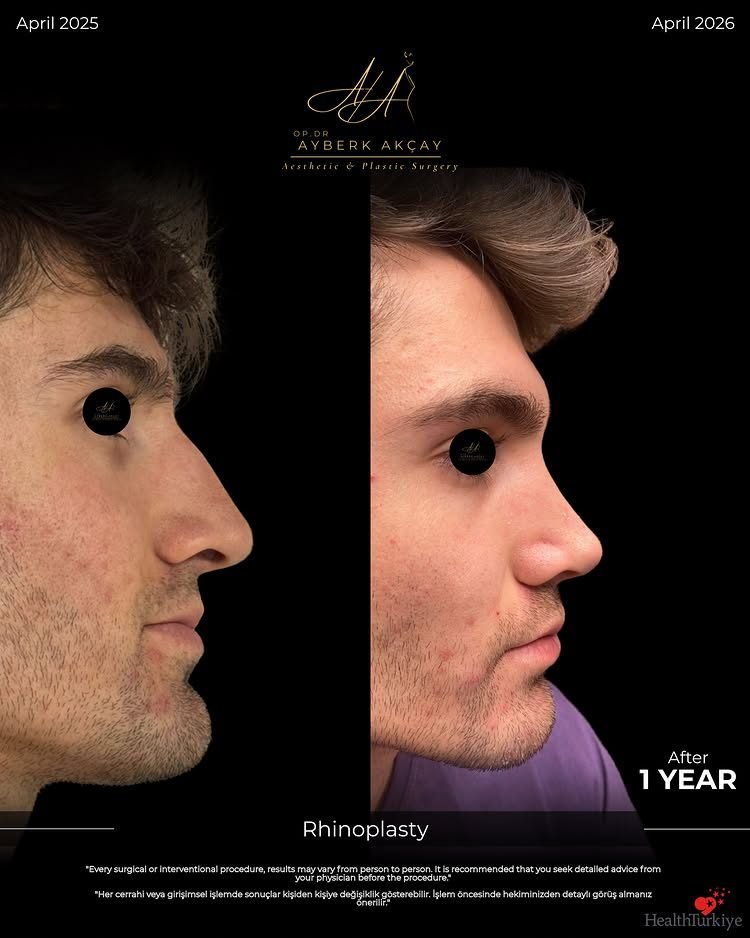 Rinoplastia antes y después, un año, de perfil