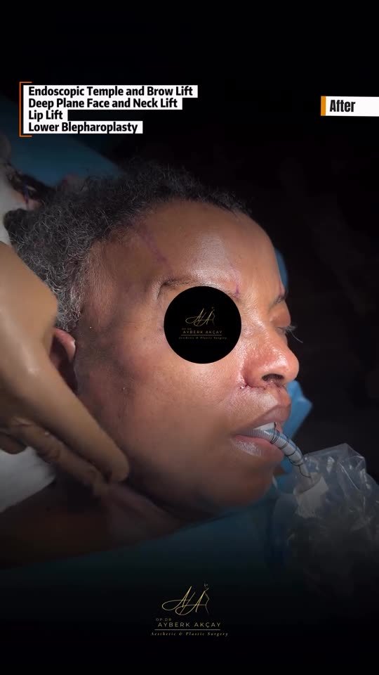 Surgical footage poster: deep plane facelift result on the operating table (graphic)