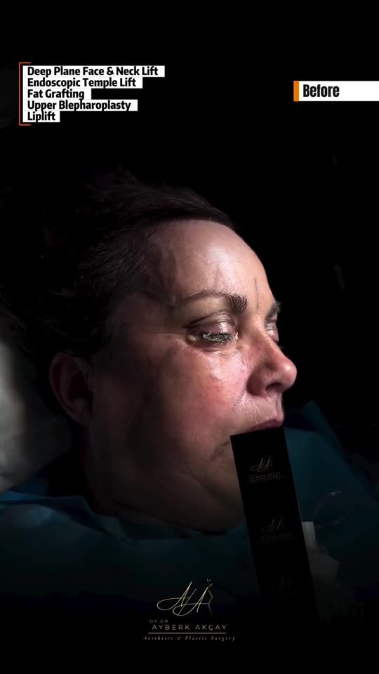 Surgical footage poster: five facial procedures performed in one session (graphic)