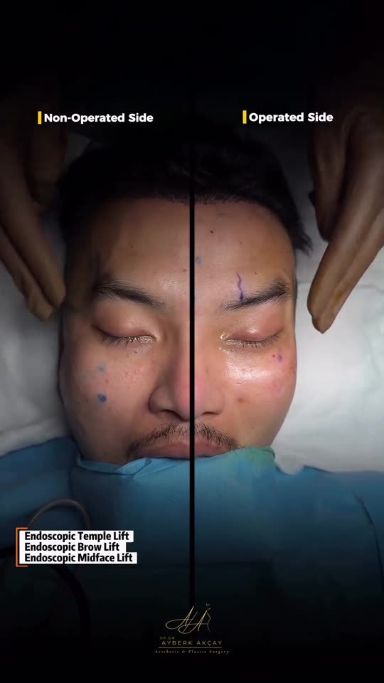 Surgical footage poster: comparison of operated and non-operated side during a facelift (graphic)