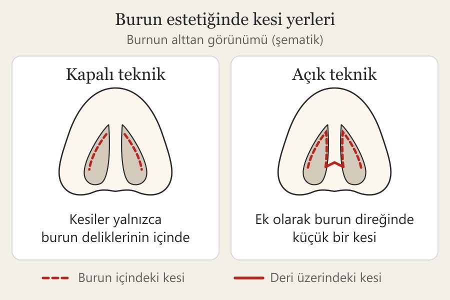 Burnun alttan görünümünde kesi yerlerini gösteren şematik çizim: kapalı teknikte kesiler burun deliklerinin içinde kalır, açık teknikte ayrıca burun direğinde küçük bir kesi bulunur