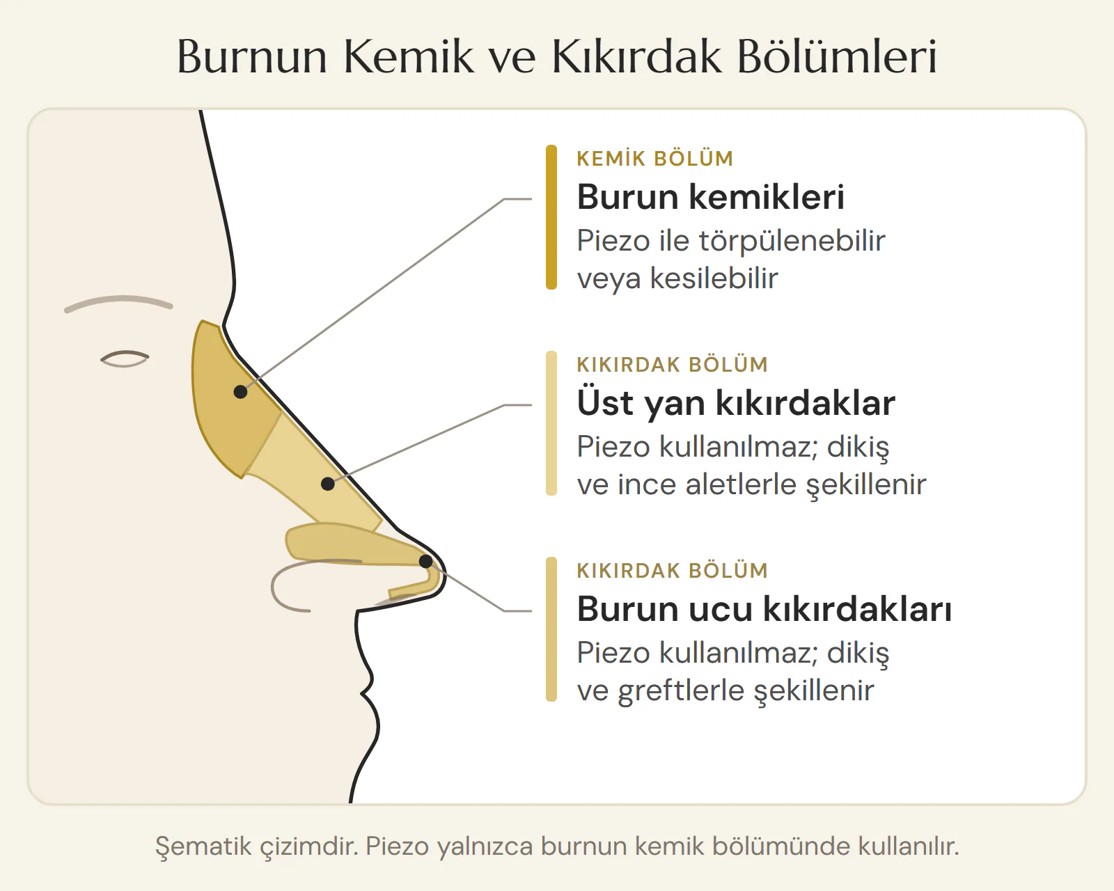 Burnun kemik ve kıkırdak bölümlerini gösteren şematik yan görünüm: piezo yalnızca üst bölümdeki burun kemiklerinde kullanılır, üst yan kıkırdaklar ve burun ucu kıkırdakları ise dikiş, ince aletler ve greftlerle şekillendirilir